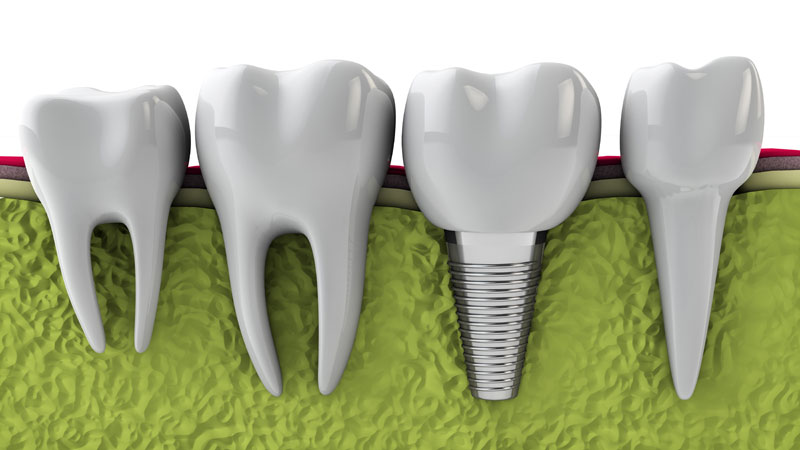 Виды имплантации зубов и цены
