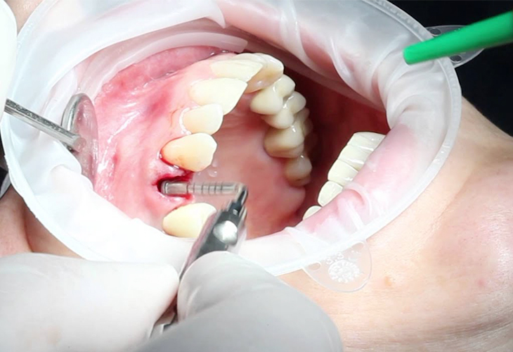 имплантация после удаления зуба