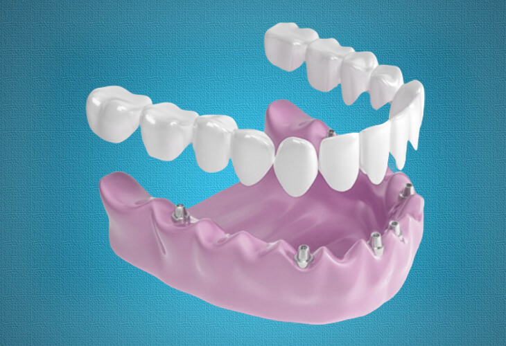 имплантация зубов 6 in 1
