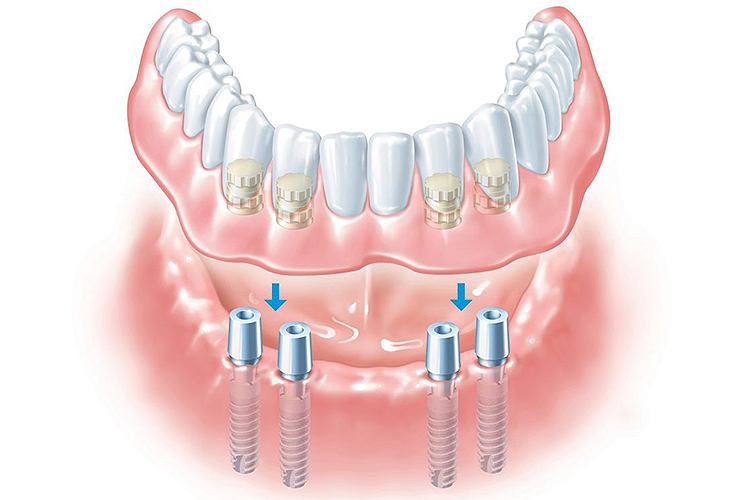 имплантация нижних зубов