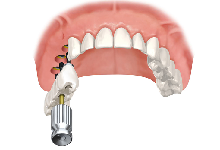 Импланты зубов под ключ и их стоимость