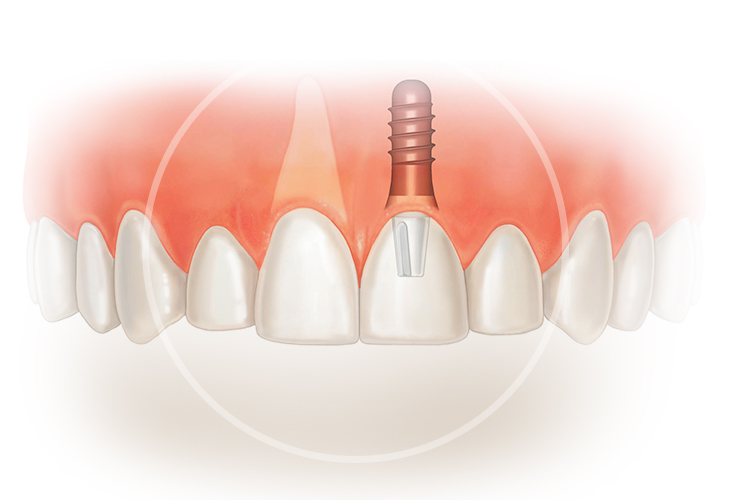импланты на верхние зубы фото