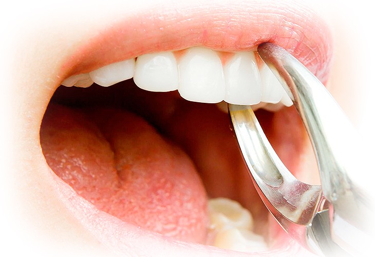 удаление верхнего зуба