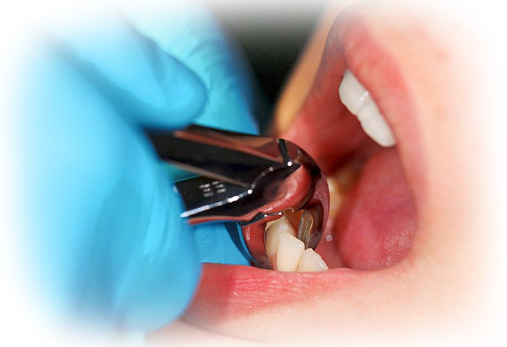 удаление нижних зубов