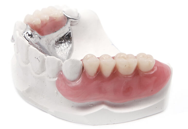 протезирование зубов без имплантов