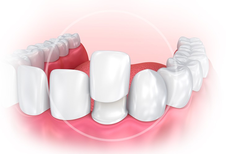 Цены на зубное протезирование металлокерамикой