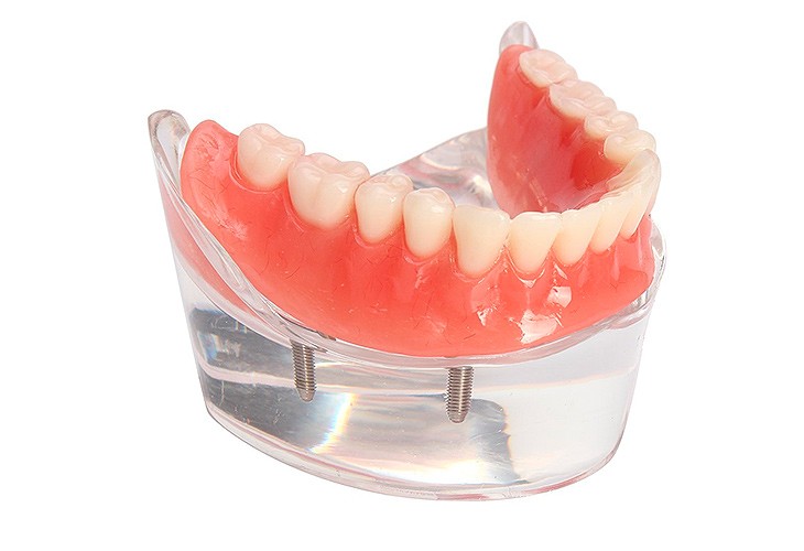 протезирование зубов нижней челюсти
