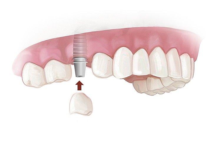 протезирование верхних зубов