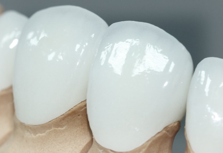 безметалловое протезирование зубов