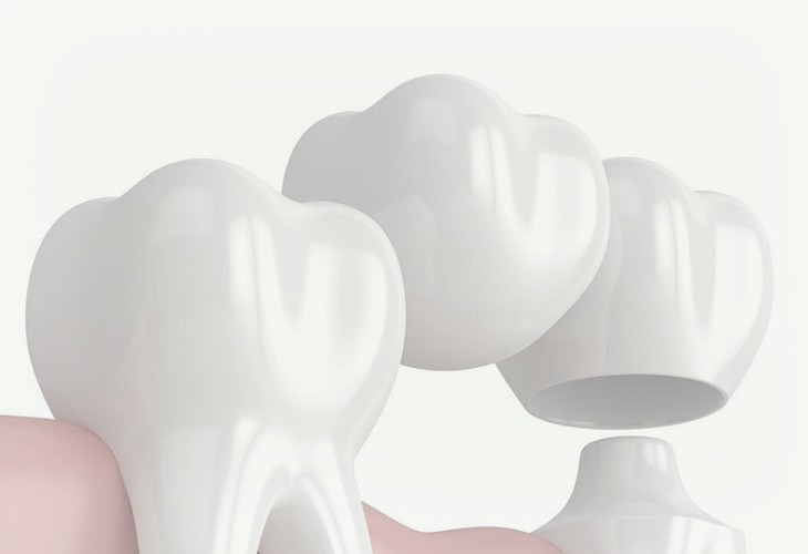протезирование зубов коронки
