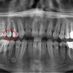 ОПТГ - планируется лечение 25 зуба