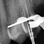 рентген-контроль 25 зуба в процессе лечения