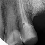 рентген-конроль 25 зуба - каналы запломбированы для дальнейшего протезирования