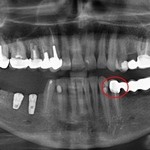 ОПТГ - планируется перелечивание 45 зуба