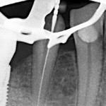 рентген-контроль в процессе лечения 45 зуба
