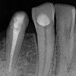 рентген-контроль 45 зуба - каналы запломбированы для дальнейшего протезирования