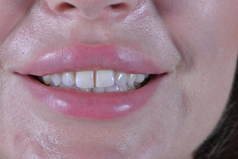 съемный зубной протез на нижнюю челюсть