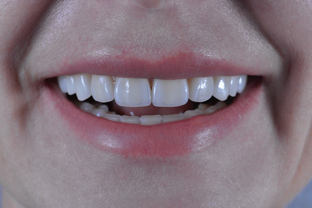зубы до и после отбеливания